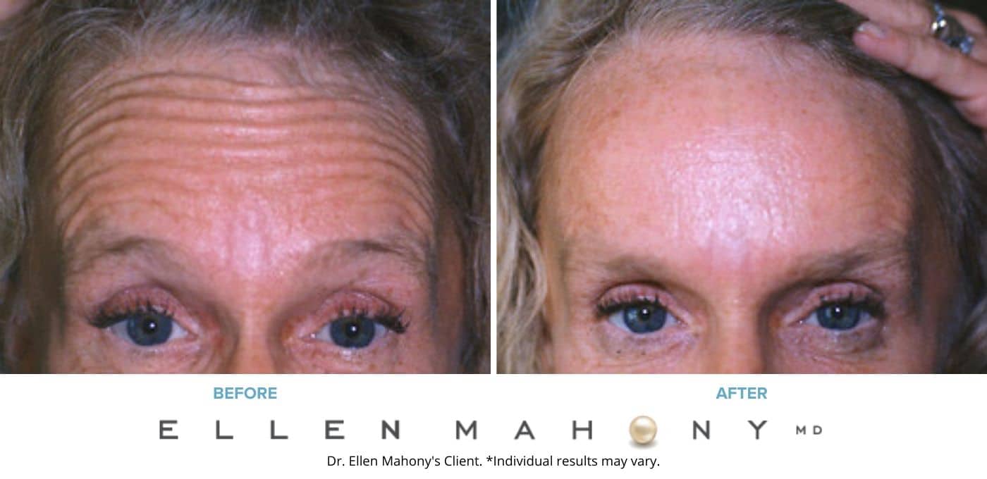 Before and After Image: Case #3370 - front