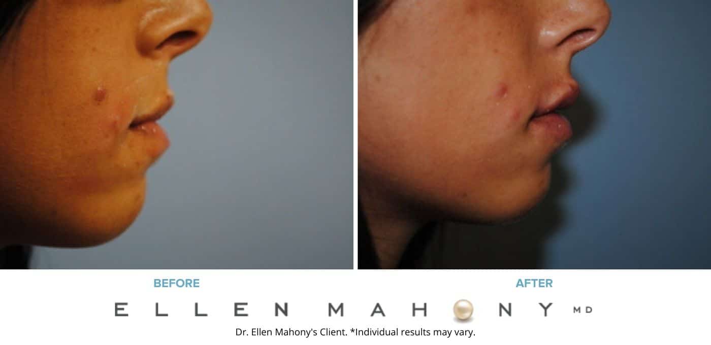 Before and After Image: Case #3382 - right-side
