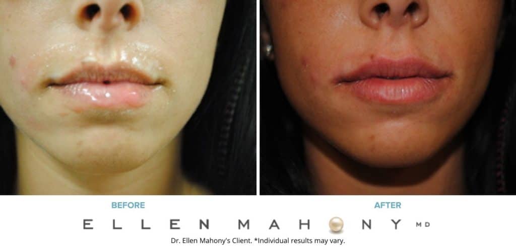 Before and After Image: Case #3382 - front