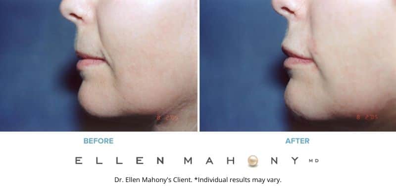Before and After Image: Case #3387 - left-side