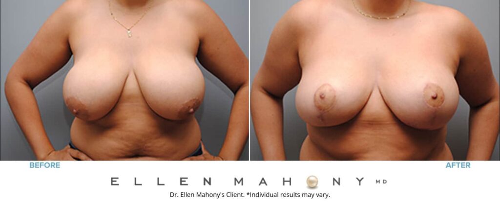 Before and After Image: Case #4862 - front