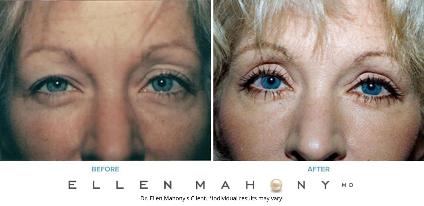 Before and After Image: Case #4870 - front
