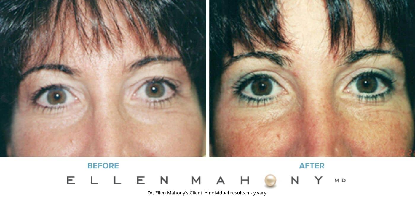 Before and After Image: Case #4877 - front