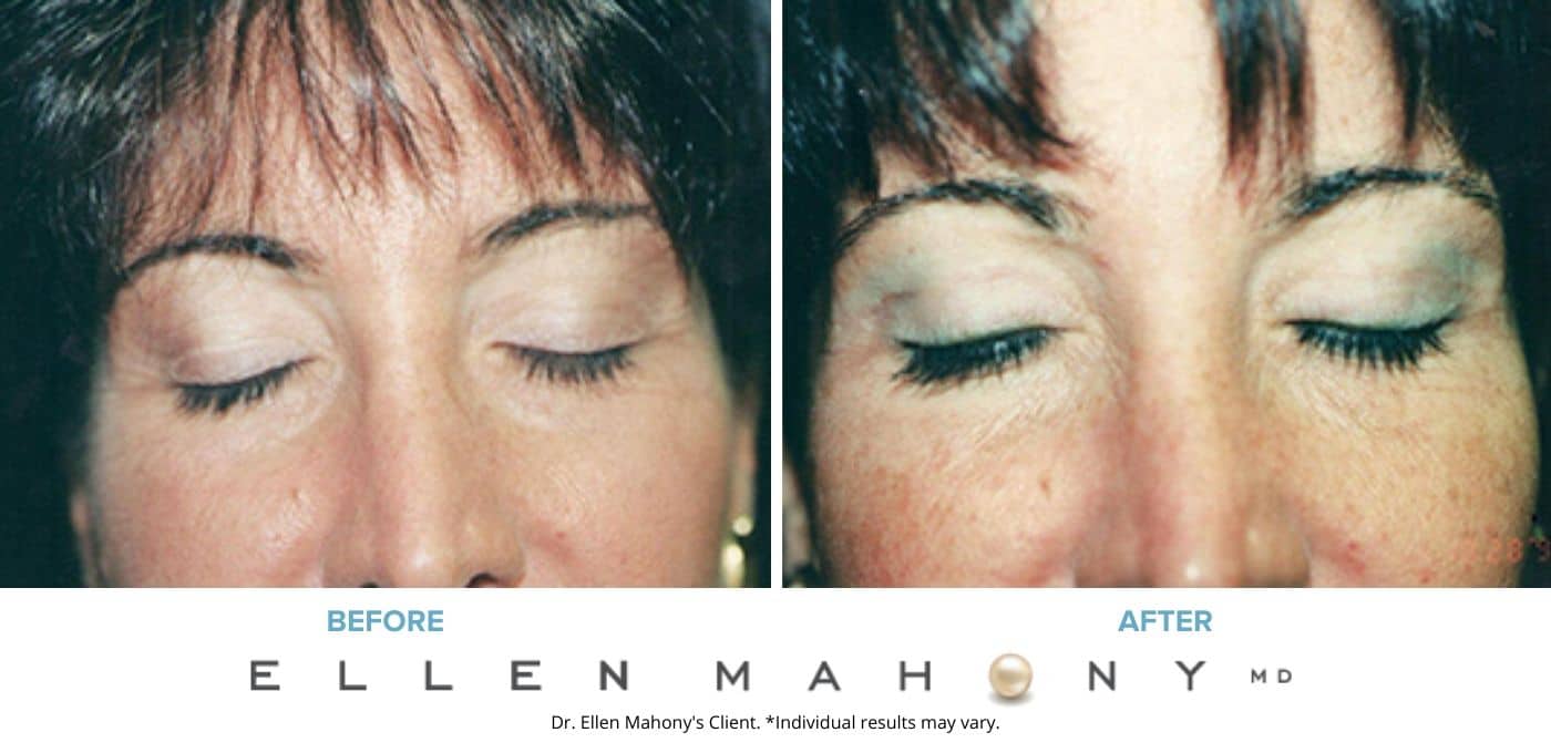 Before and After Image: Case #4877 - front