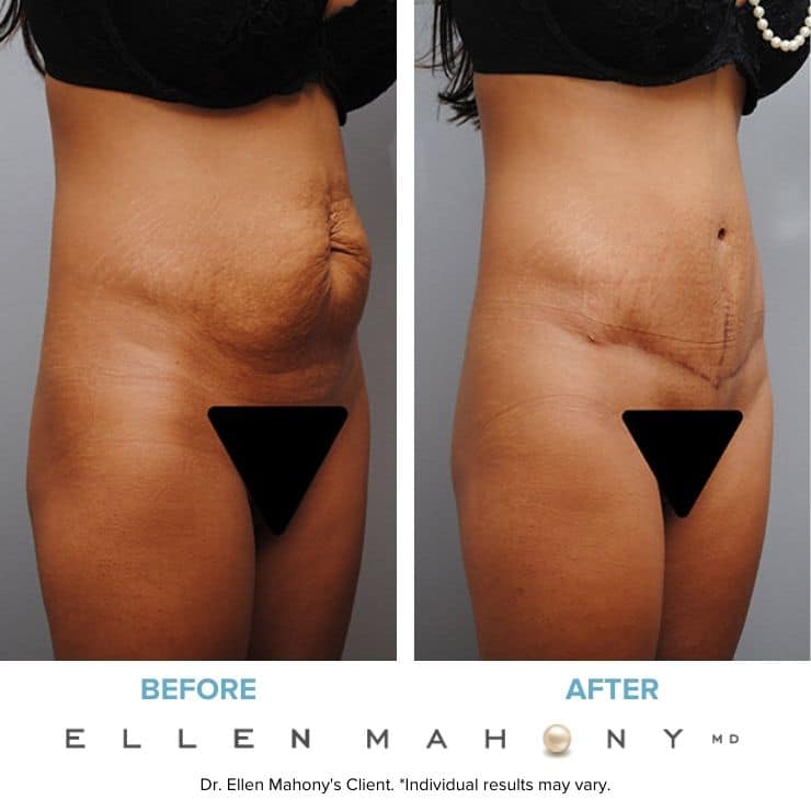 Before and After Image: Case #4918 - right-front-oblique