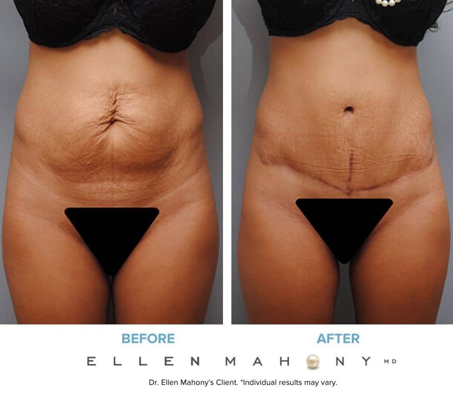 Before and After Image: Case #4918 - front