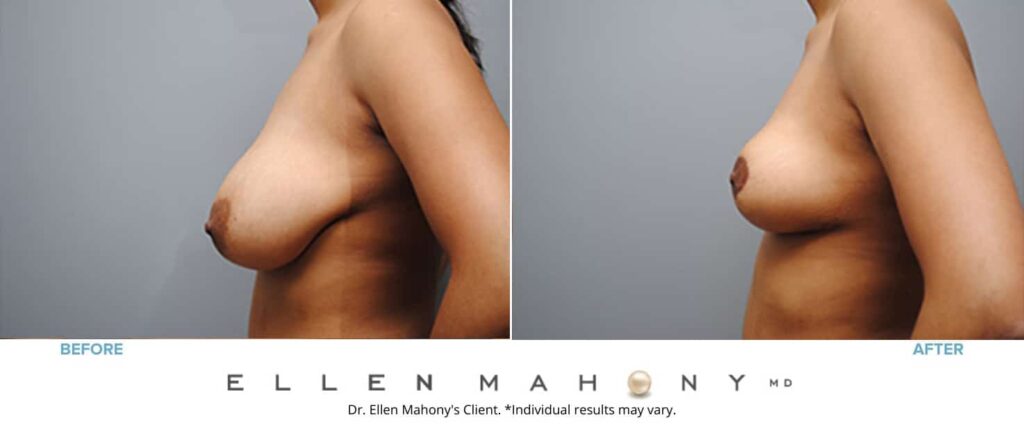 Before and After Image: Case #4927 - left-side