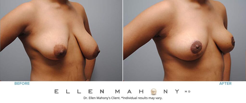 Before and After Image: Case #4927 - right-front-oblique