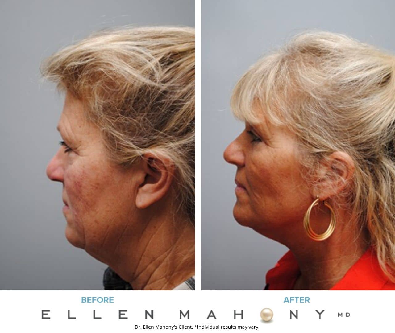 Before and After Image: Case #5055 - left-side