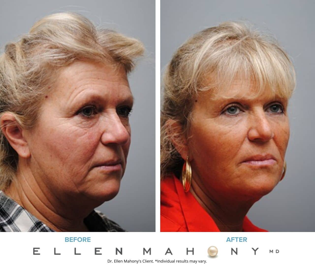 Before and After Image: Case #5055 - right-front-oblique