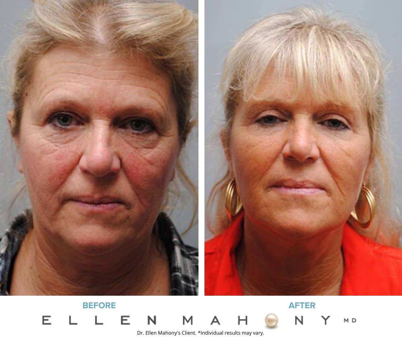 Before and After Image: Case #5055 - front