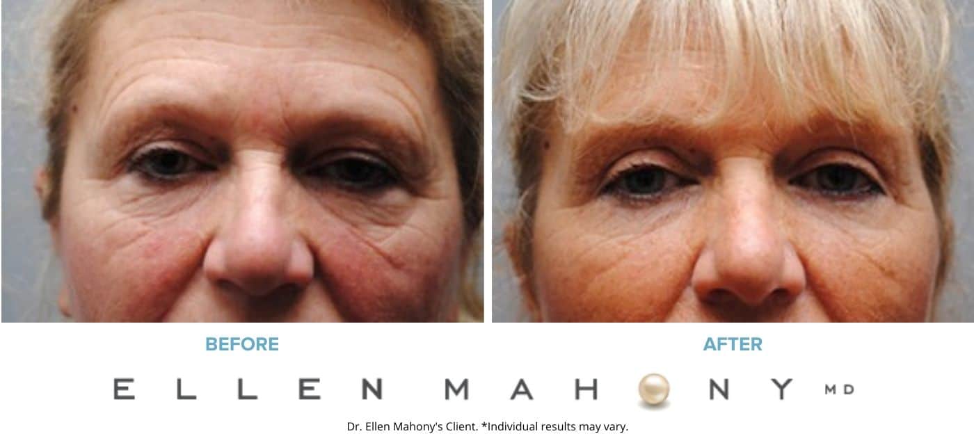 Before and After Image: Case #5055 - front