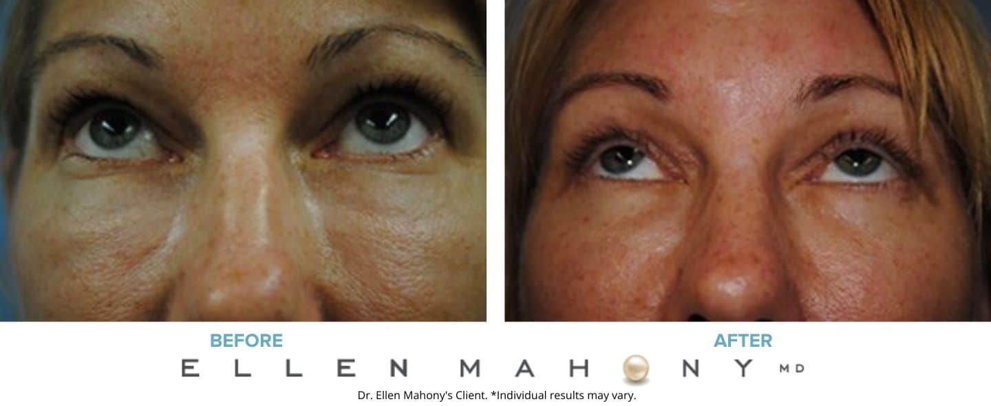 Before and After Image: Case #5072 - front