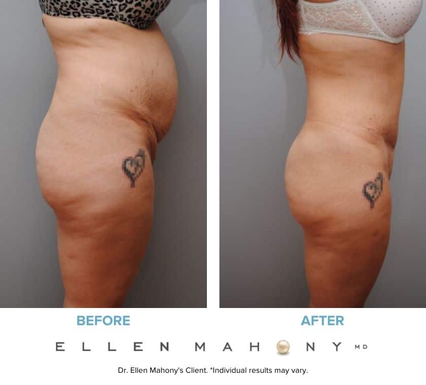 Before and After Image: Case #5357 - right-side