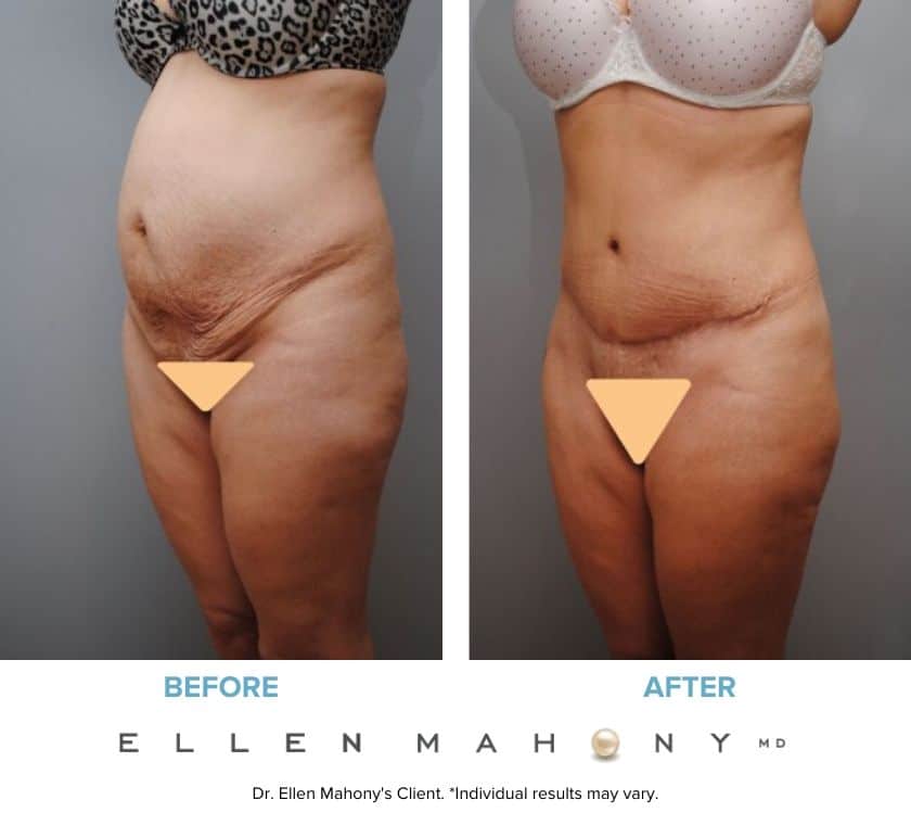 Before and After Image: Case #5357 - left-front-oblique