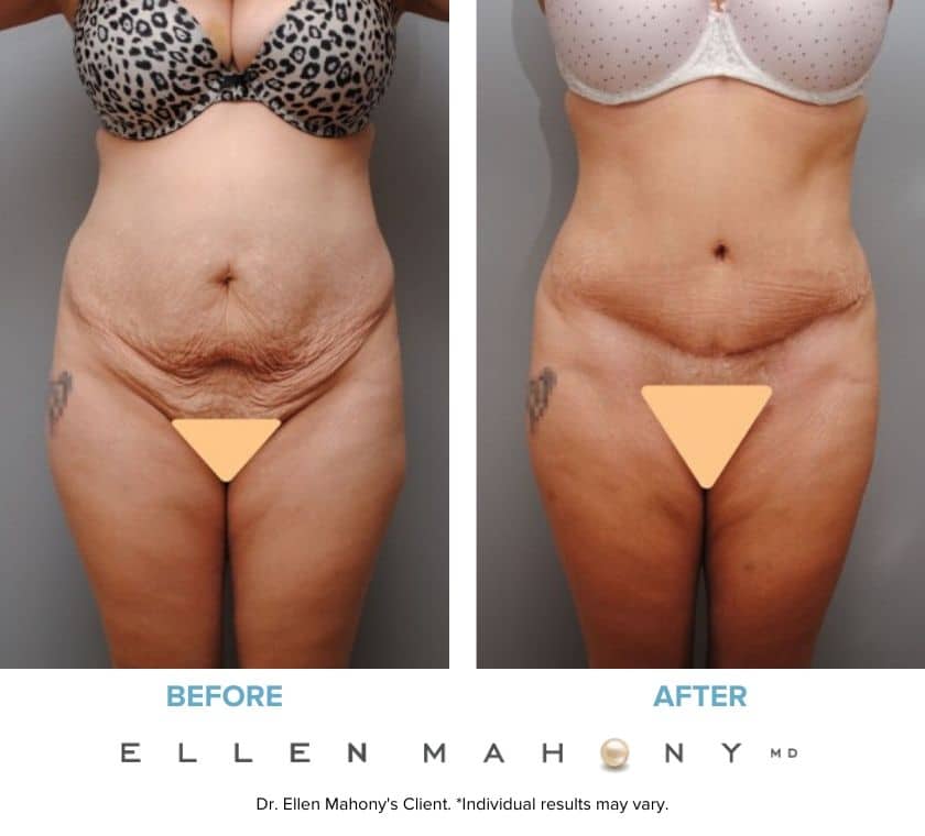 Before and After Image: Case #5357 - front