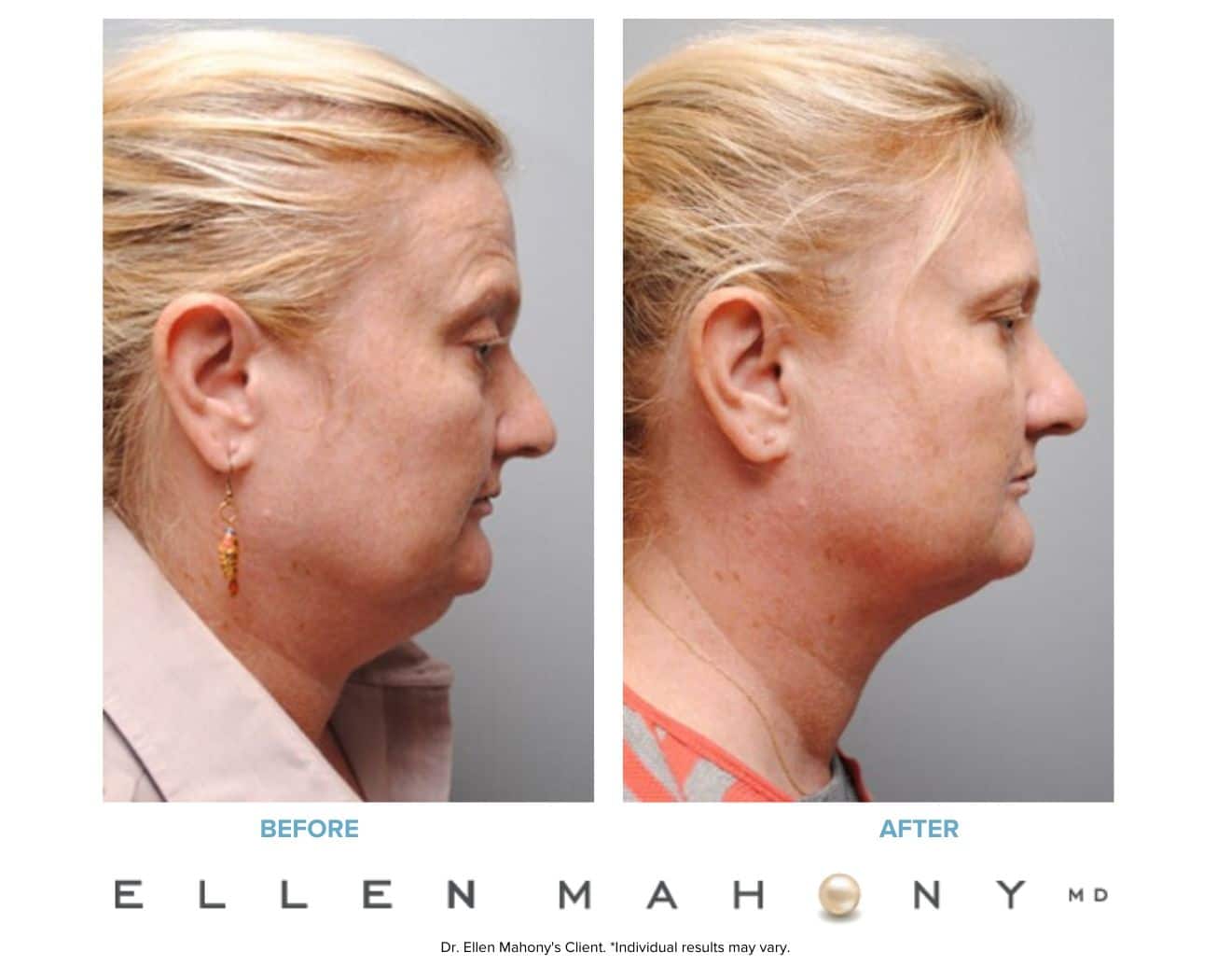Before and After Image: Case #5372 - right-side