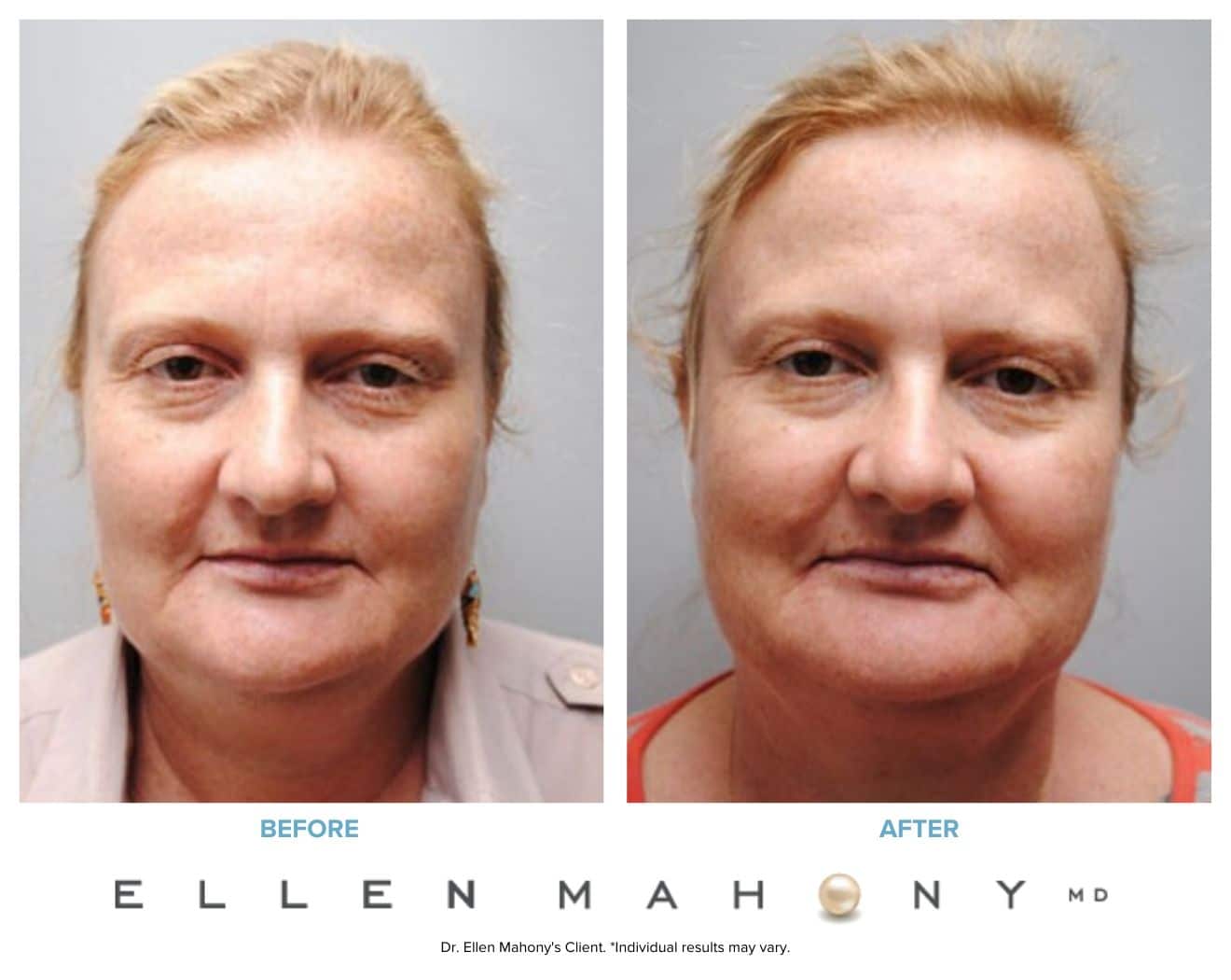 Before and After Image: Case #5372 - front