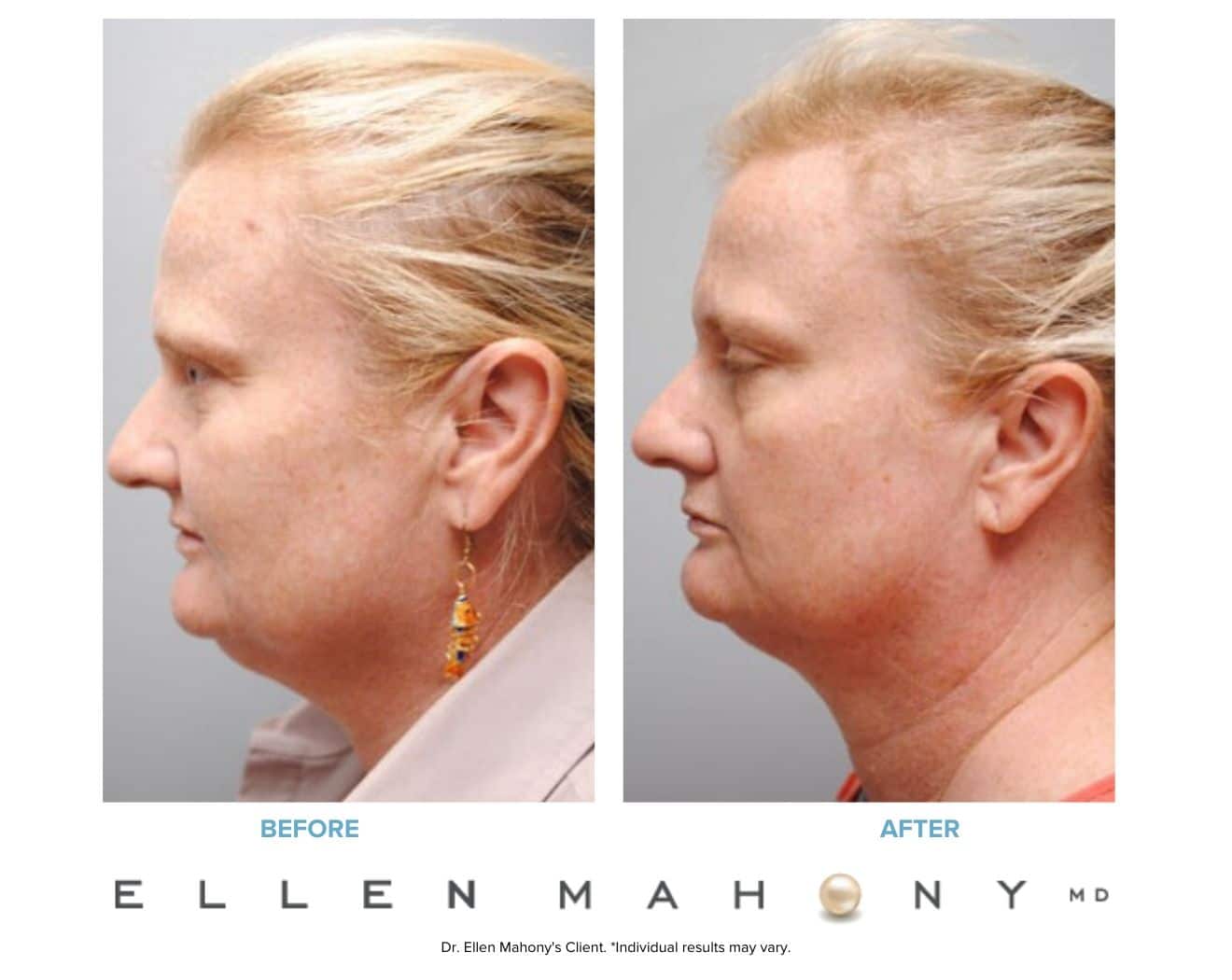 Before and After Image: Case #5372 - left-side