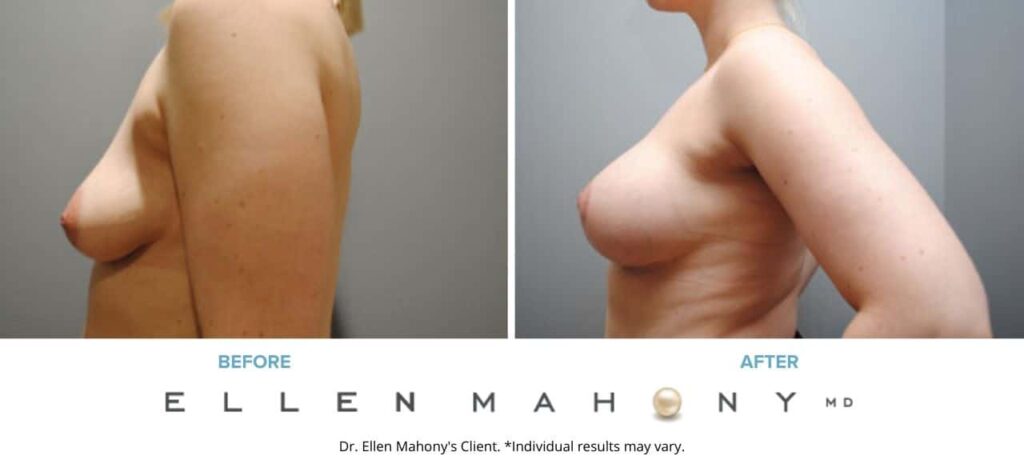 Before and After Image: Case #5957 - left-side