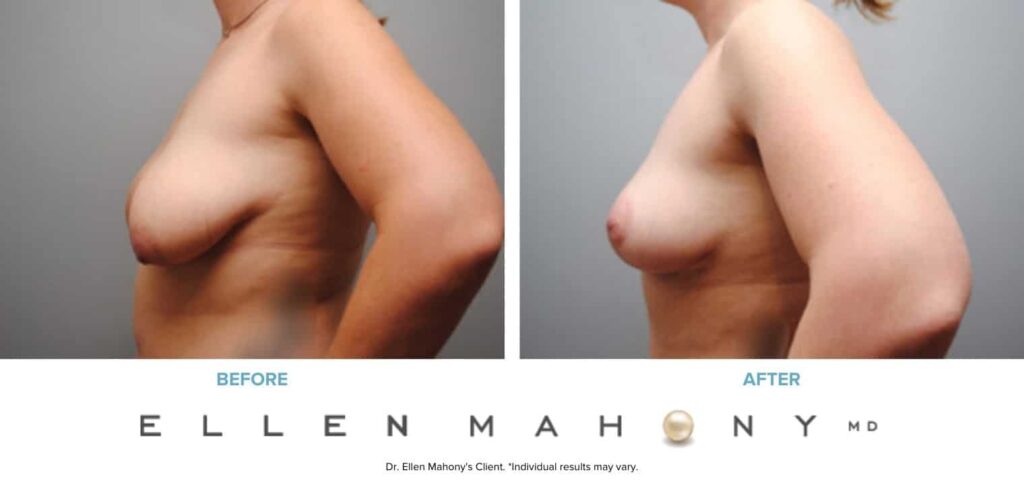 Before and After Image: Case #6172 - left-side