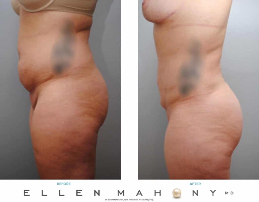 Before and After Image: Case #6172 - left-side