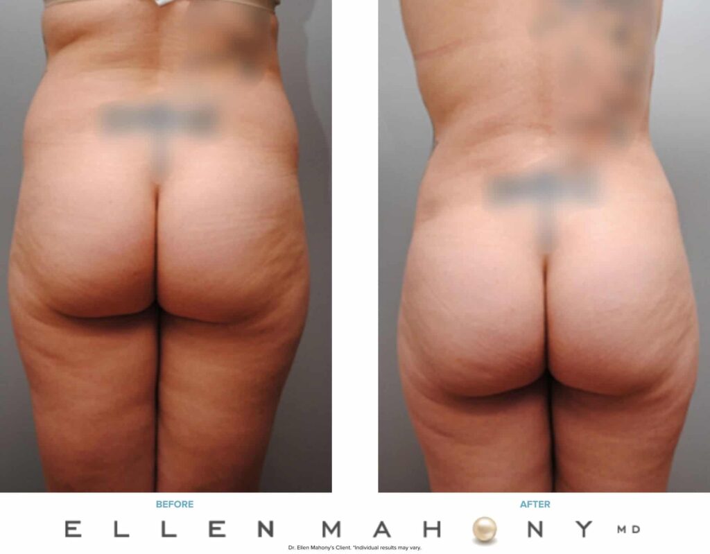 Before and After Image: Case #6172 - back