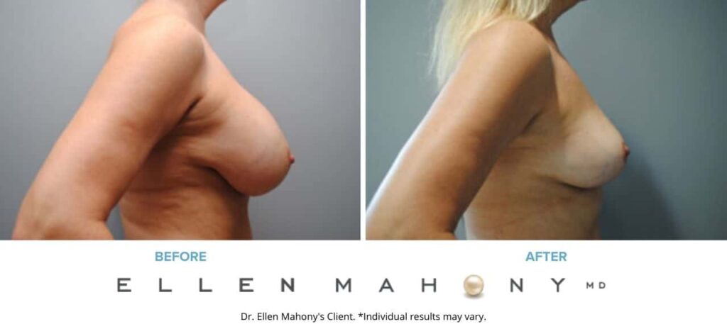 Before and After Image: Case #6184 - right-side