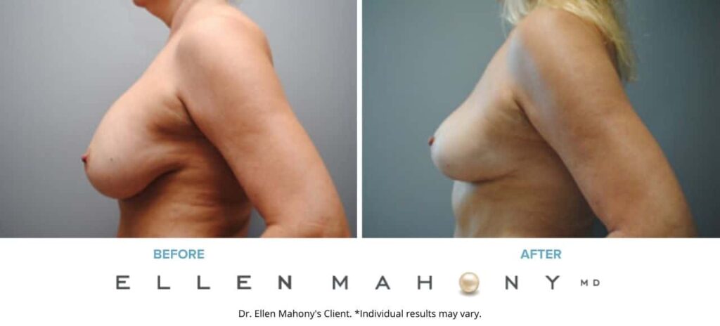 Before and After Image: Case #6184 - left-side