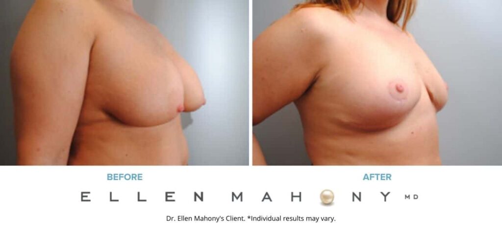 Before and After Image: Case #6207 - right-side