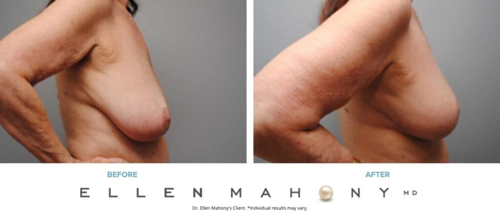 Before and After Image: Case #6216 - right-side