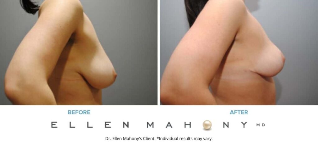 Before and After Image: Case #6244 - right-side