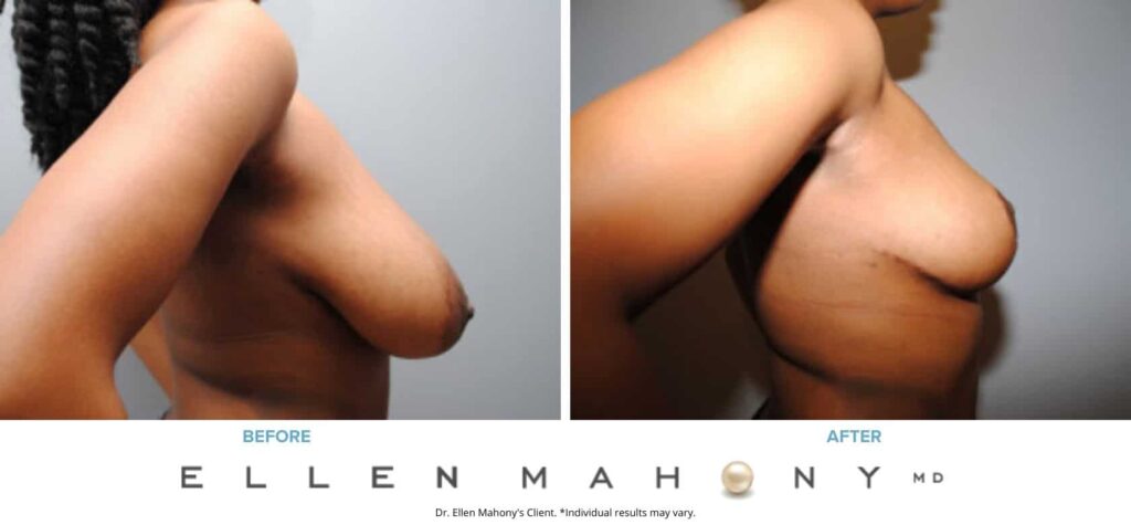 Before and After Image: Case #6305 - right-side
