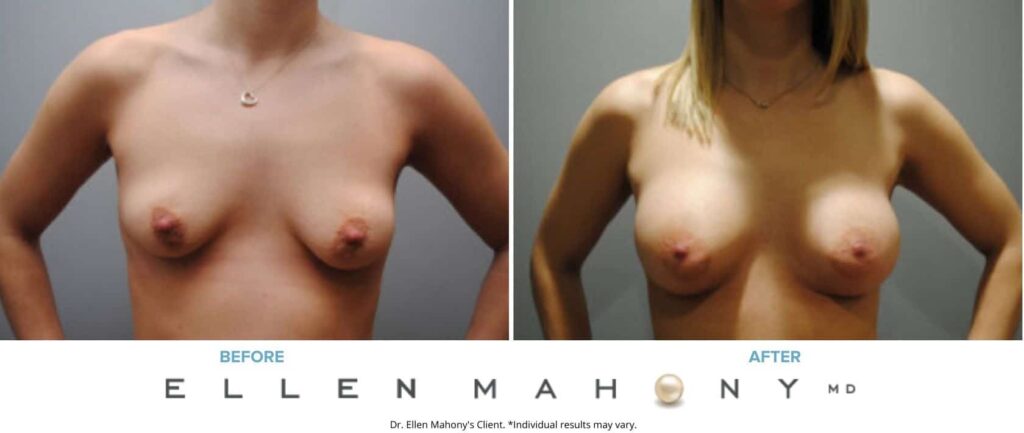 Before and After Image: Case #6352 - front