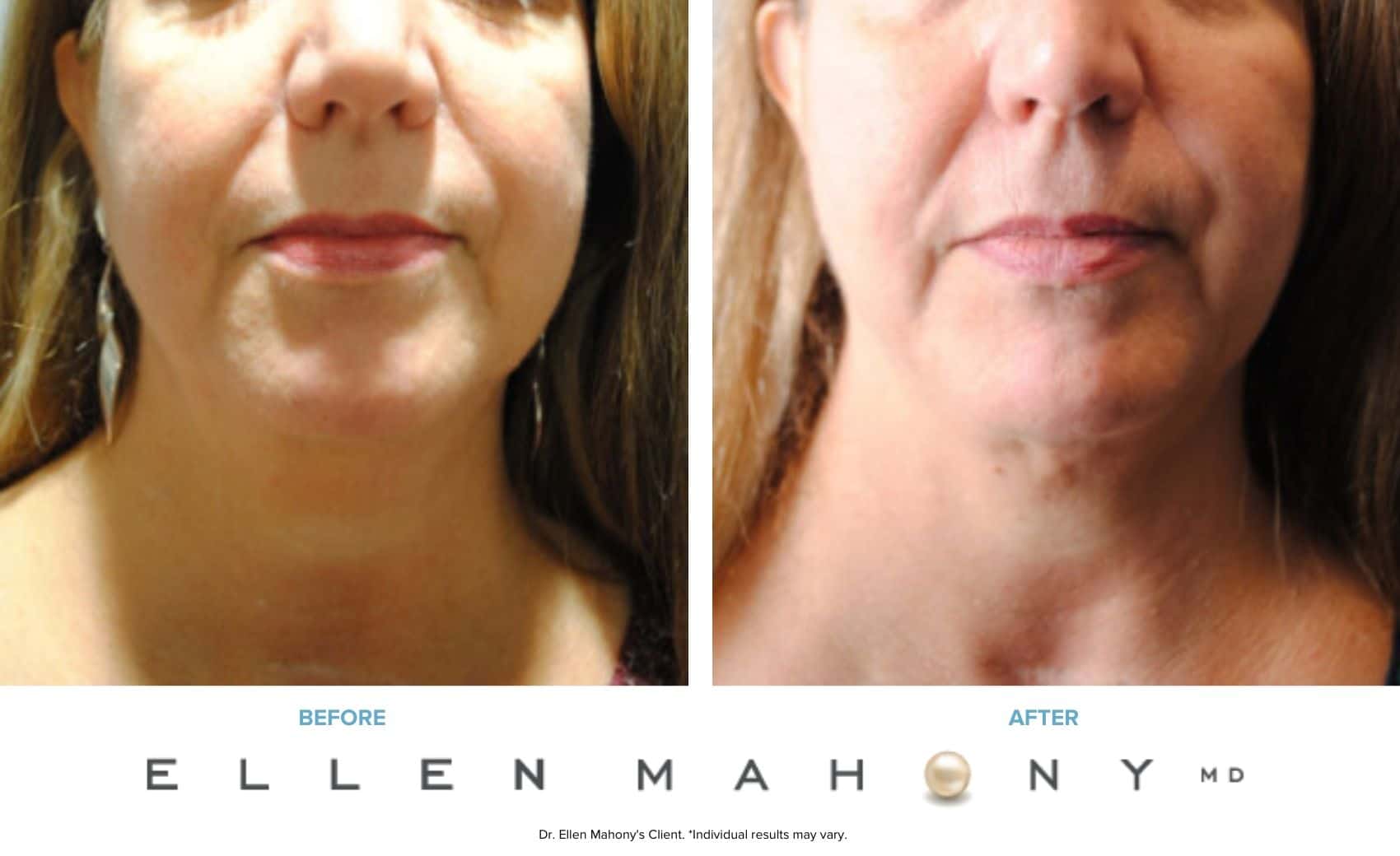 Before and After Image: Case #6627 - front