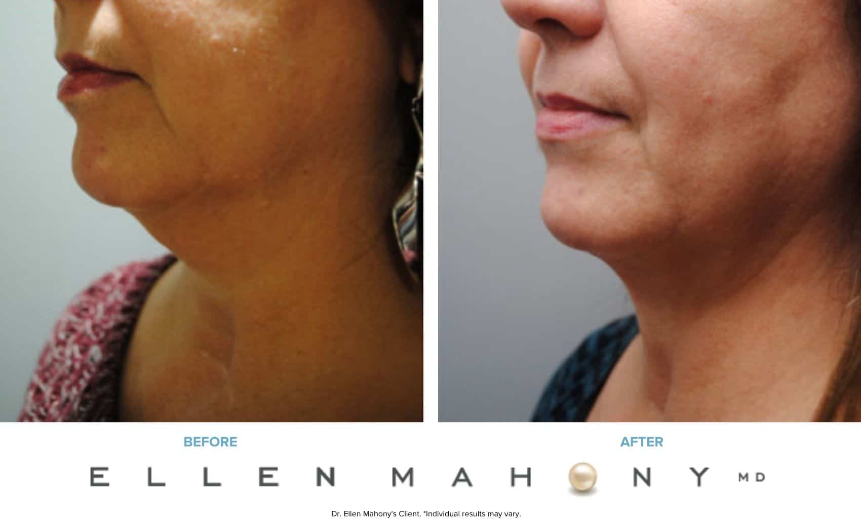 Before and After Image: Case #6627 - left-front-oblique