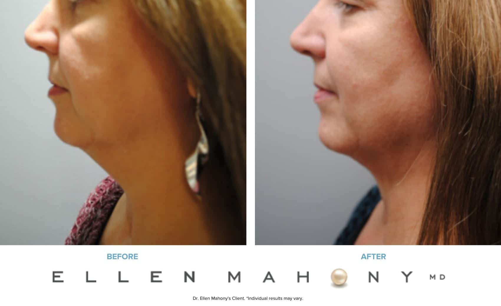 Before and After Image: Case #6627 - left-side