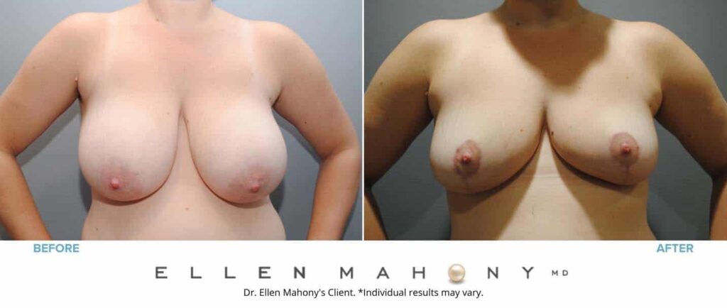 Before and After Image: Case #6810 - front