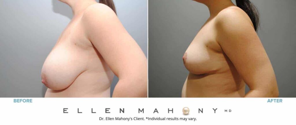 Before and After Image: Case #6810 - left-side