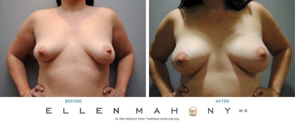 Before and After Image: Case #7068 - front