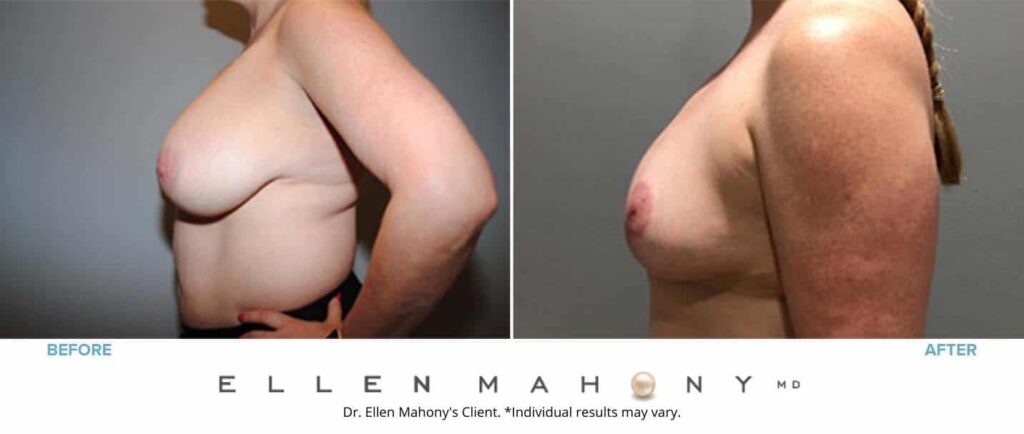 Before and After Image: Case #7214 - left-side