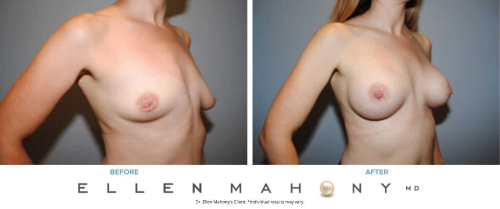 Before and After Image: Case #7321 - right-front-oblique