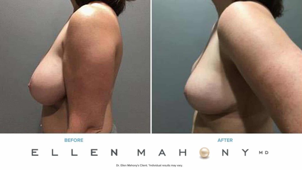 Before and After Image: Case #7346 - left-side