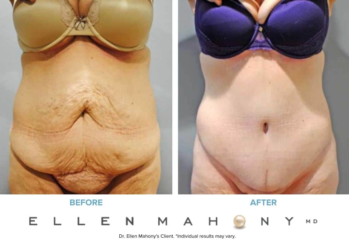 Before and After Image: Case #7390 - front