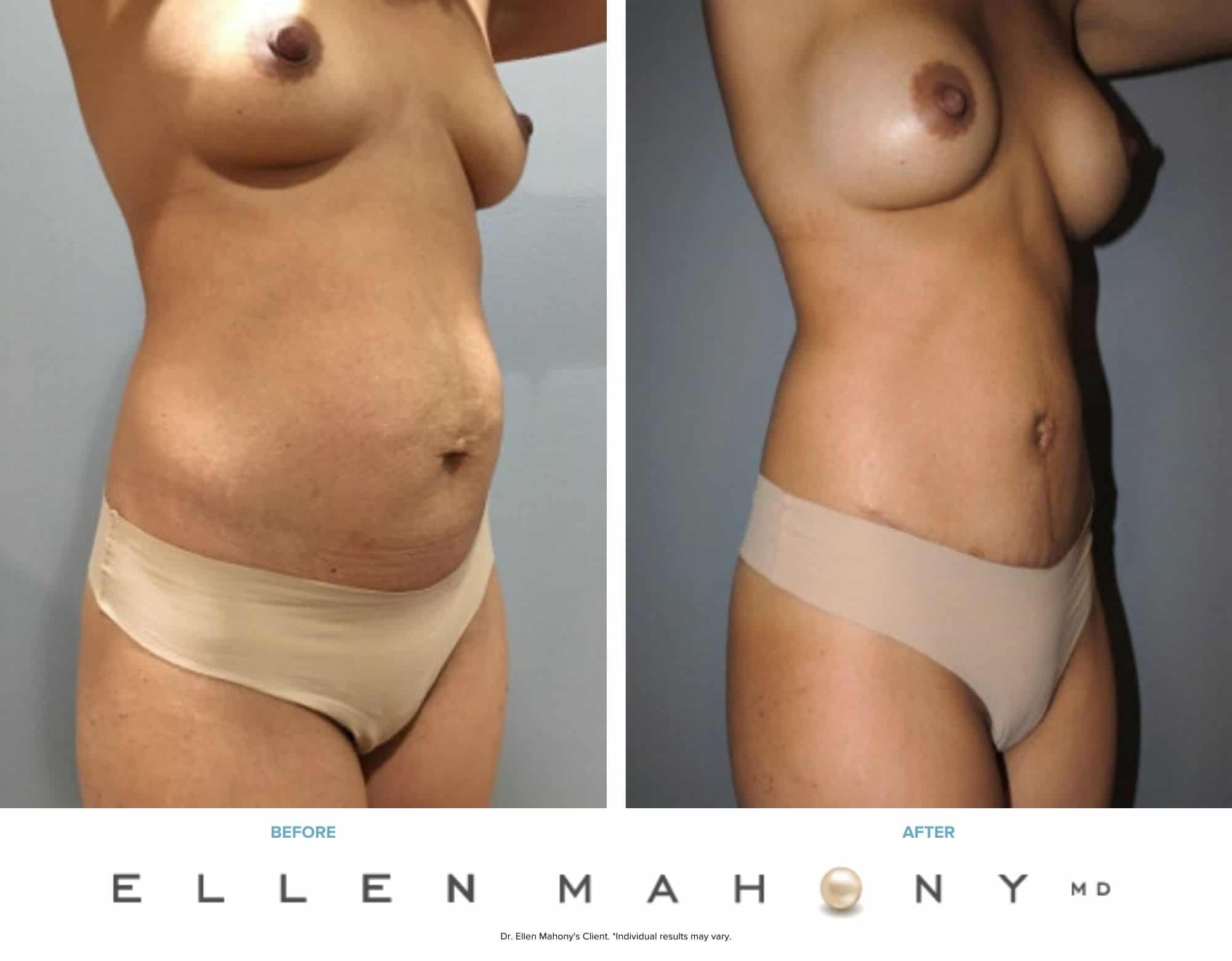 Before and After Image: Case #7503 - right-front-oblique