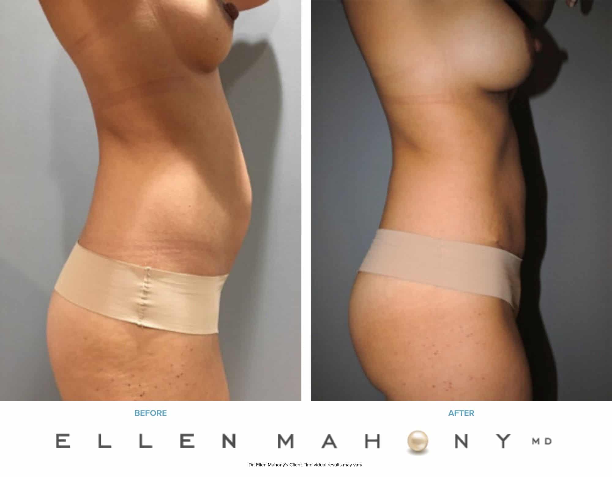 Before and After Image: Case #7503 - right-side