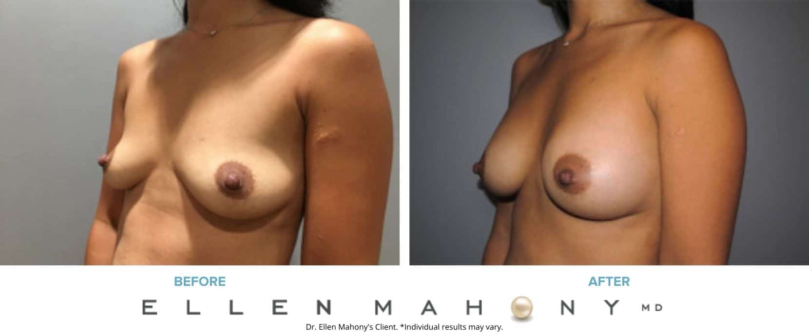 Before and After Image: Case #7503 - left-front-oblique