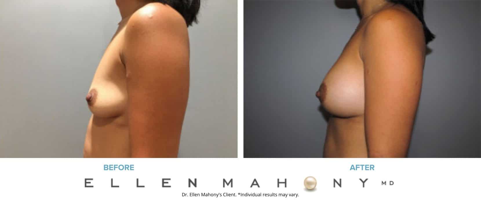 Before and After Image: Case #7503 - left-side