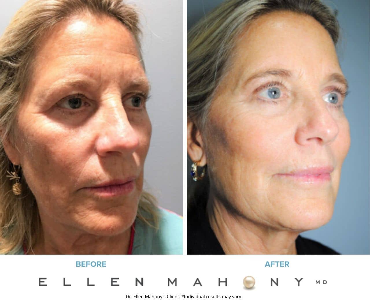 Before and After Image: Case #7507 - right-front-oblique