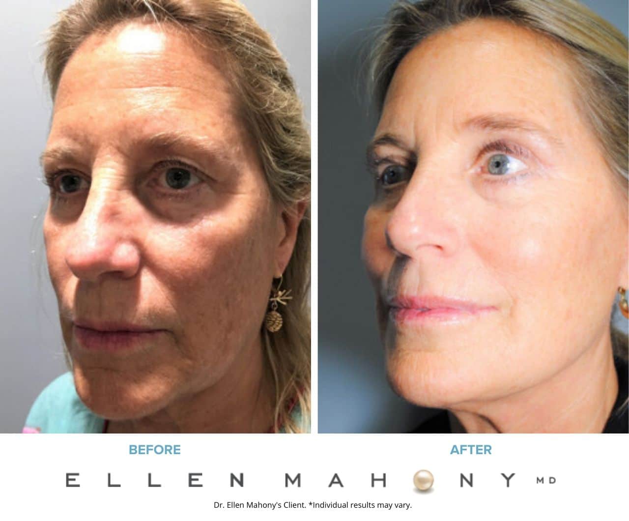 Before and After Image: Case #7507 - left-front-oblique